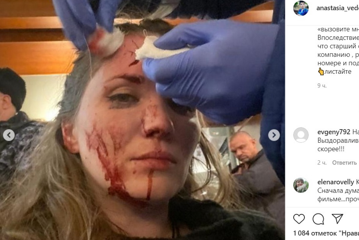 Экс-супруга актера Епифанцева показала фото лица после драки в Петербурге