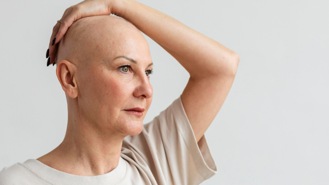 выпадение волос, волосы, лысина, лысый, лысая